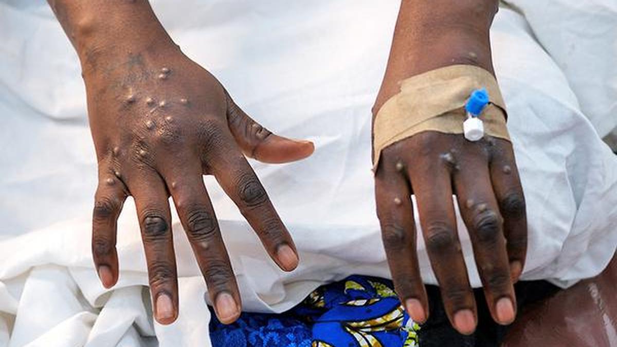 UK identifies four cases of new mpox variant, the first cluster outside Africa